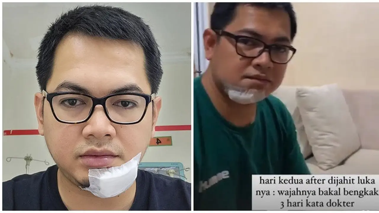 Jatuh hingga Alami Robek di Dagu, Ini 6 Potret Kondisi Tommy Kurniawan