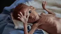Bocah Yaman yang mengalami malnutrisi parah terbaring di ranjang perawatan Aslam Health Center (AP Photo/Hani Mohammed)