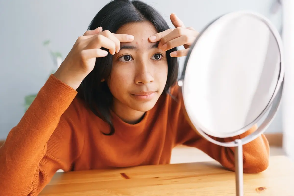 Kerap Bikin Remaja Minder, Begini Cara Mengatasi Jerawat yang Tepat
