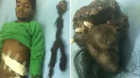 Kembar Parasit dalam Tubuh Remaja Tumbuh Rambut dan Gigi