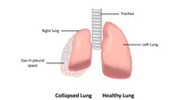Apa itu Pneumothorax? Gangguan Paru-Paru yang Diidap Winter aespa