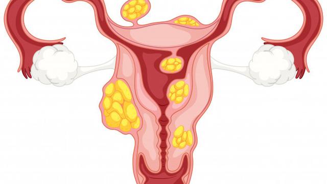 Gambar Ilustrasi Fibroid atau Polip Uterus