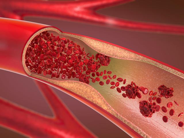 Ketahui Penyakit Peredaran Darah Yang Berbahaya Jangan Disepelekan Hot Liputan6 Com