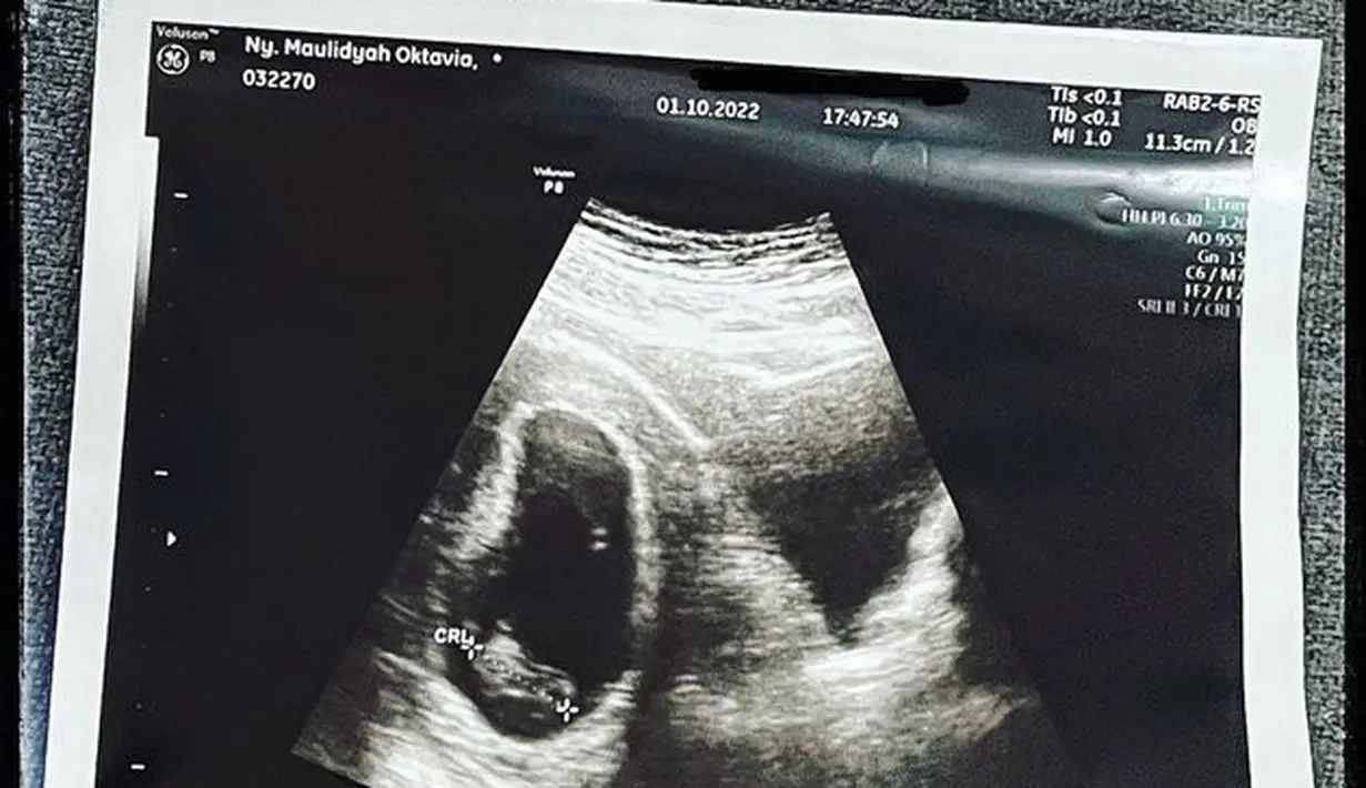 7 hari setelah periksa ke dokter kandungan pada awal Oktober lalu, Via membuka fakta kepada publik bahwa ia sedang hamil. Namun kondisi kandungannya bermasalah. (instagram.com/viavallen)