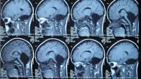 MRI pasien yang kehilangan otak kecil (Feng Yu et al)