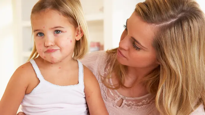 Jaga Imun Keluarga untuk cegah Cacar Air (Monkey Business Images/Shutterstock)