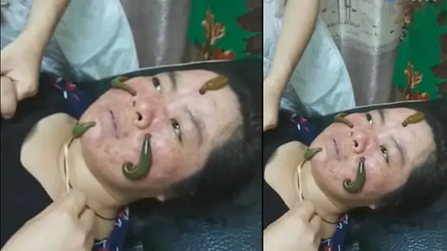 Terapi kecantikan untuk jerawat menggunakan lintah. (V.qq.com)
