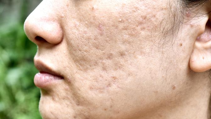 Cara Menghilangkan Bopeng Bekas Jerawat Dengan Bahan Alami Ampuh Banget Hot Liputan6 Com