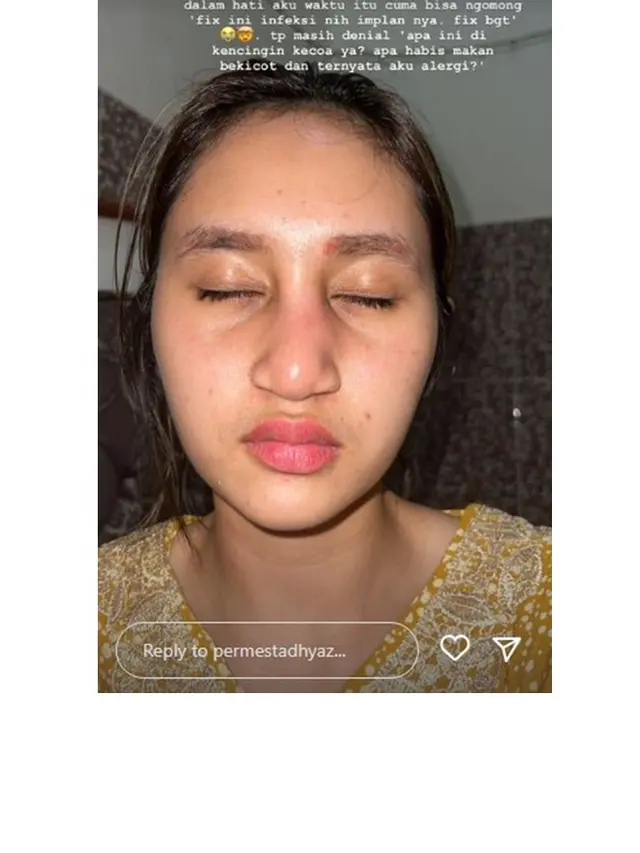 12 Foto Kronologi Dhyaz Anak Farida Nurhan Alami Infeksi Hidung hingga Angkat Implan