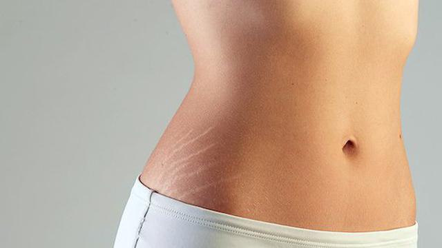 15 Cara Menghilangkan Stretch Mark Di Paha Dan Bokong Secara Alami Beauty Fimela Com