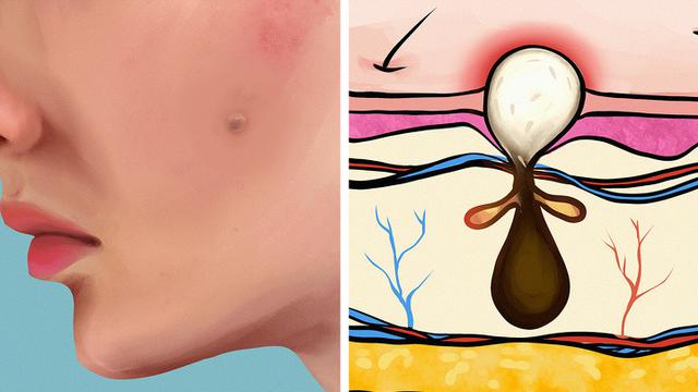 10 Jenis Jerawat Di Wajah Pria Dewasa yang Sering Muncul, Kenali Penyebab dan Cara Mencegahnya