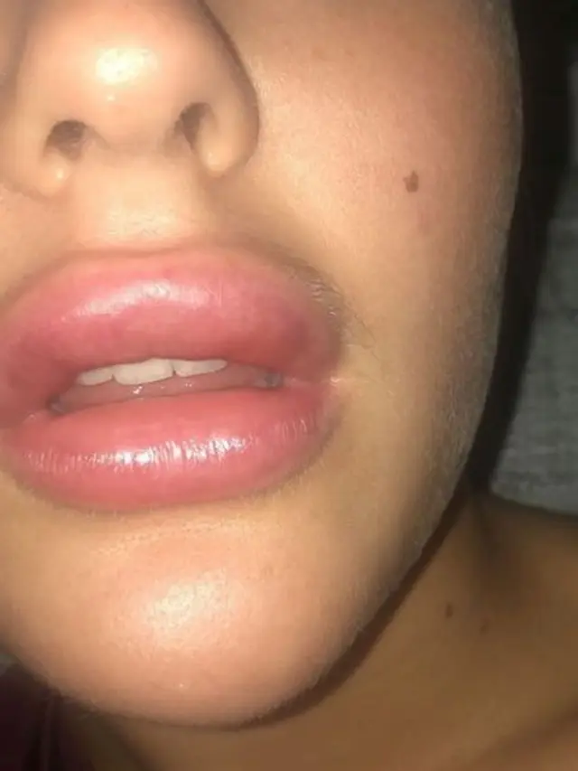 Lakukan Suntik Filler dengan Harga Murah, Bibir Wanita Ini Malah Bengkak Seperti Mau Meletus