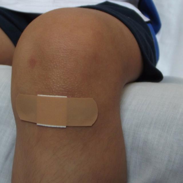 6 Tips Menyamarkan Bekas Luka Pengganggu Penampilan Lifestyle Liputan6 Com