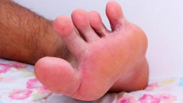 Masalah Kesehatan yang Ditandai dengan Kaki Gatal