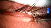 Seorang bocah 5 tahun asal Tiongkok mengeluhkan rasa gatal luar biasa pada matanya