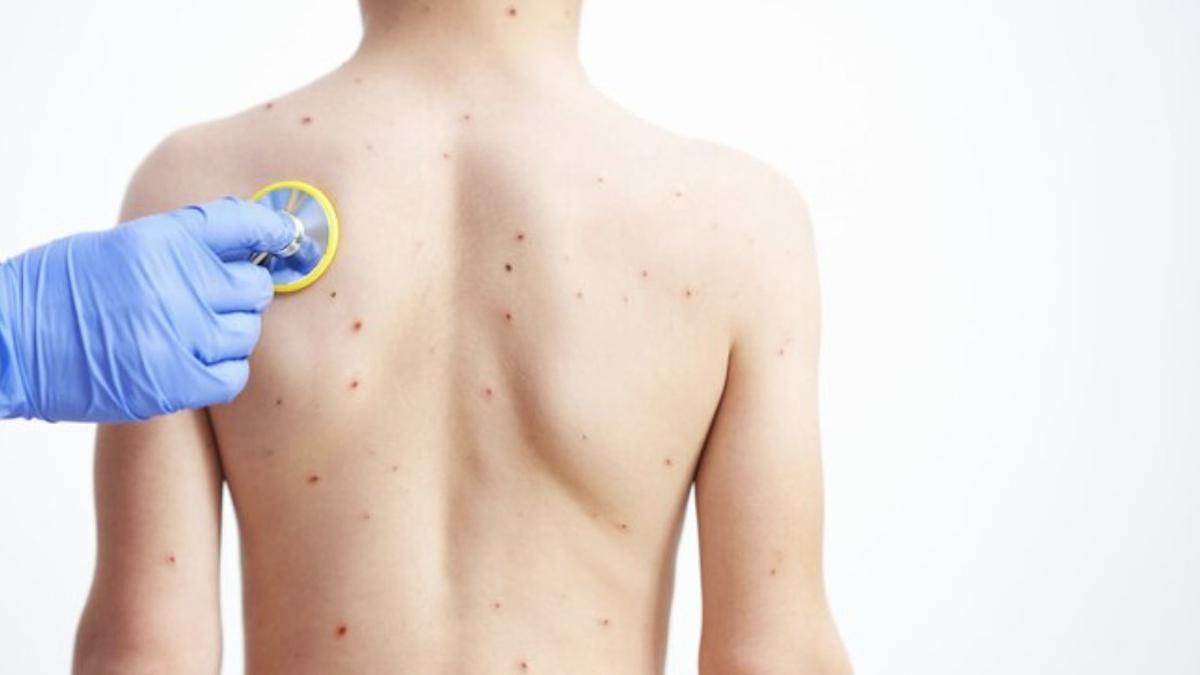 Waspada Monkeypox! Begini Cara Mencegahnya Agar Tetap Aman