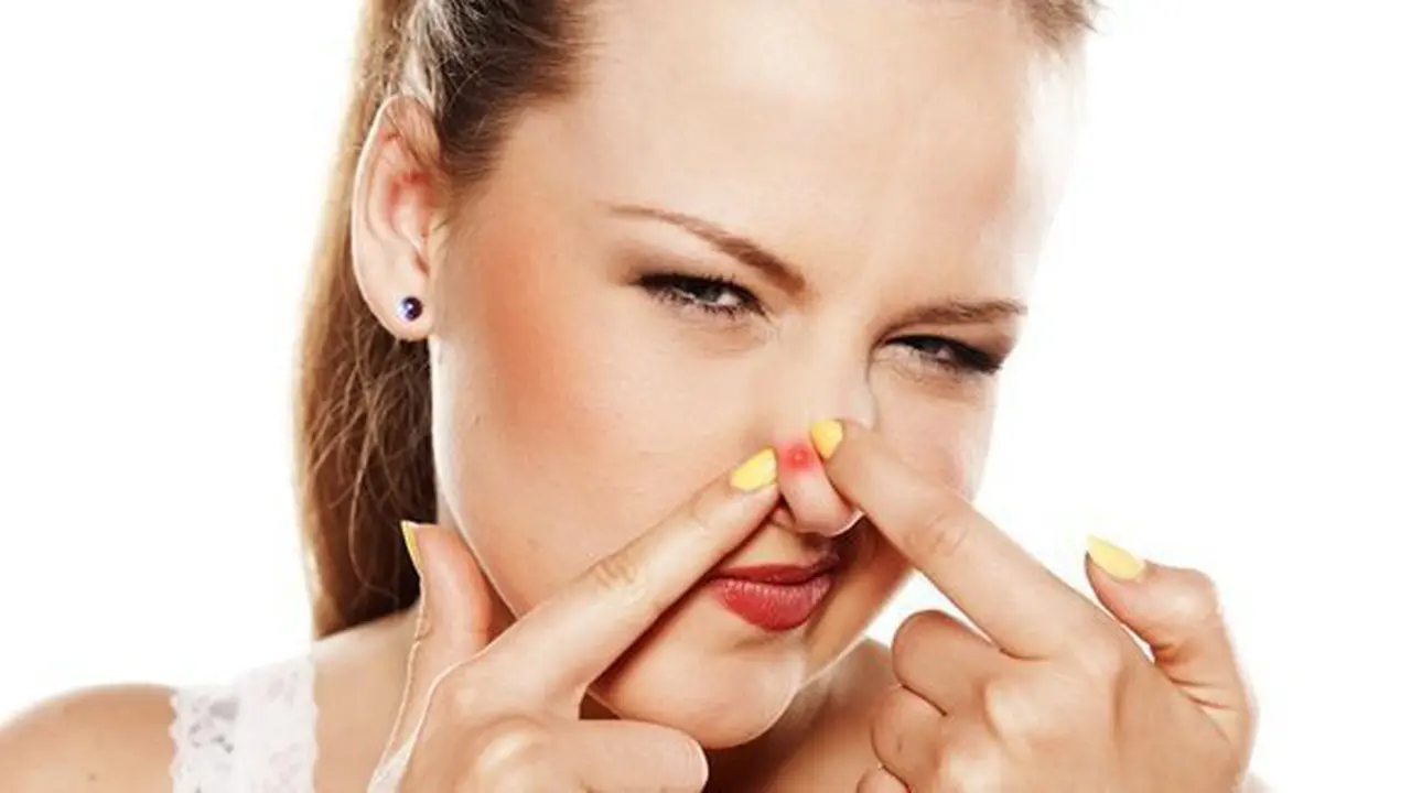Jerawat selalu bikin kesal/copyright: thinkstockphotos.com
