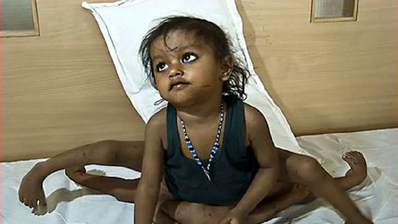 3 Orang Ini Dilahirkan dengan Anggota Tubuh Berlebih