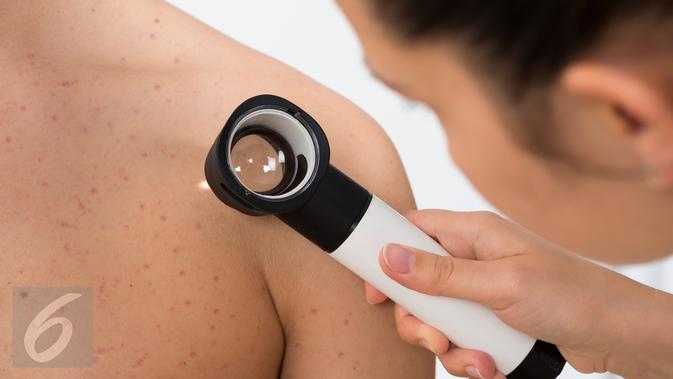 Memar muncul pada punggung. (iStockphoto)