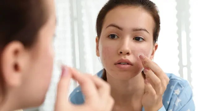 Acne Patch Lagi Populer untuk Meredakan Jerawat, Seberapa Efektif Sih Penggunaannya?