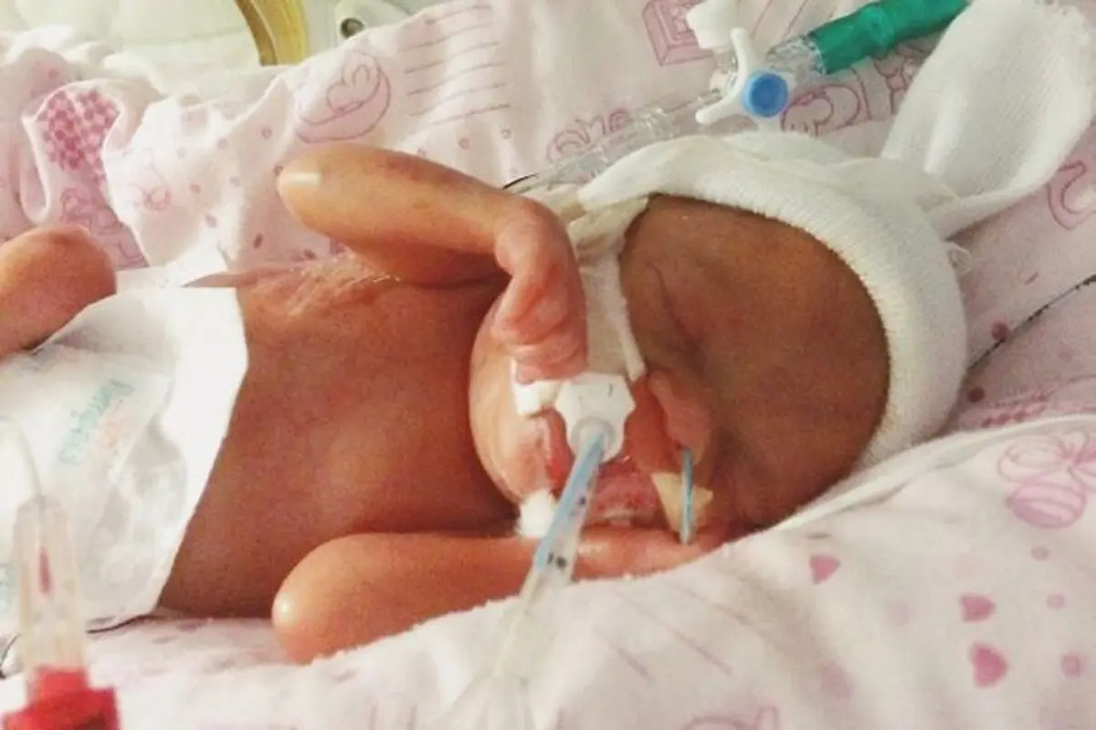 Lahir Prematur, Bayi Ini Lahir Hanya Seukuran Gelas Bir