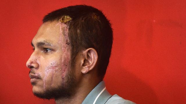 Untuk pertama kalinya sejak diserang air keras, Faisal Halim muncul di hadapan publik.