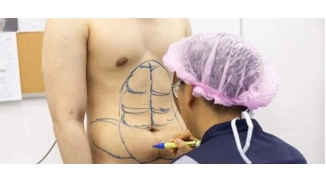 Pria Ini Rela Lakukan Operasi Plastik Demi Punya Perut Six Pack Hasilnya Bikin Geleng Kepala