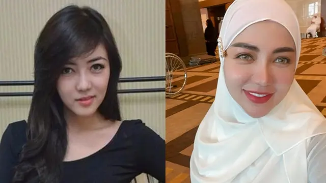 Beda Penampilan 9 Artis Sebelum vs Setelah Operasi Plastik, Bikin Pangling