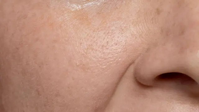 Ini Hal yang Bisa Menyumbat Pori-Pori Wajah dan Menyebabkan Jerawat (photo by freepik.com)