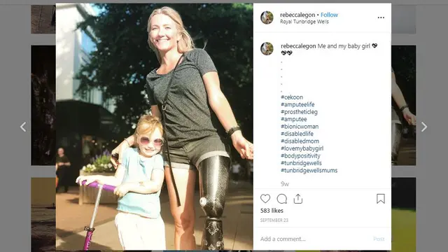 Rebecca Legon, wanita disabilitas asal Inggris yang kini bisa menerima keadaan dirinya