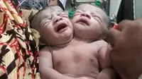 Kelahiran bayi berkepala dua ini buat publik Bangladesh heboh