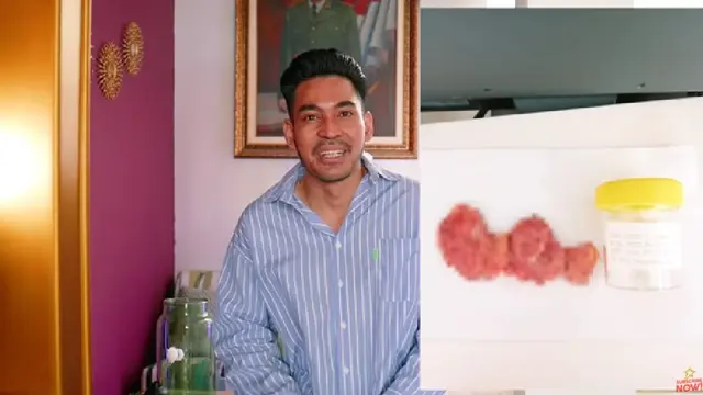 Penampakan tumor payudara di dada Robby Purba. (Foto: YouTube Robby Purba)