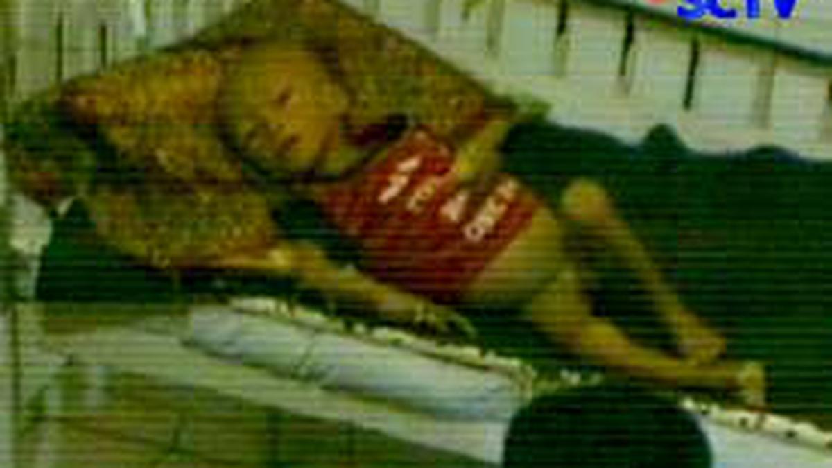 Seorang Balita Menderita Gizi Buruk News Liputan6