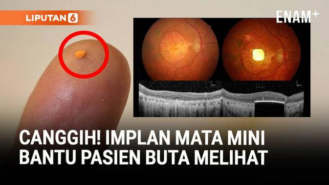 Implan Mata Mini Bantu Pasien Buta Bisa Melihat Lagi