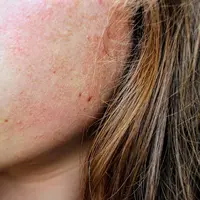 Berikut lima tanda kulitmu memerlukan eksfoliasi./copyright pexels/Jenna Hamra