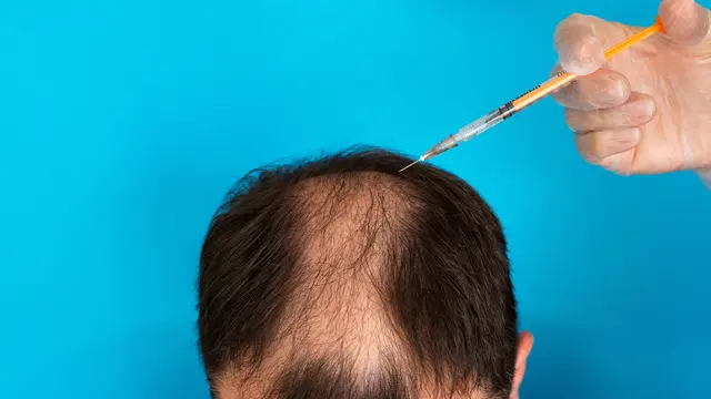 Transplantasi Rambut.