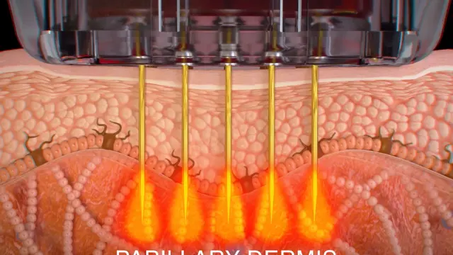 Minimalisir Tanda Penuaan Dini dalam Satu Kali Perawatan dengan Teknologi Sylfim X