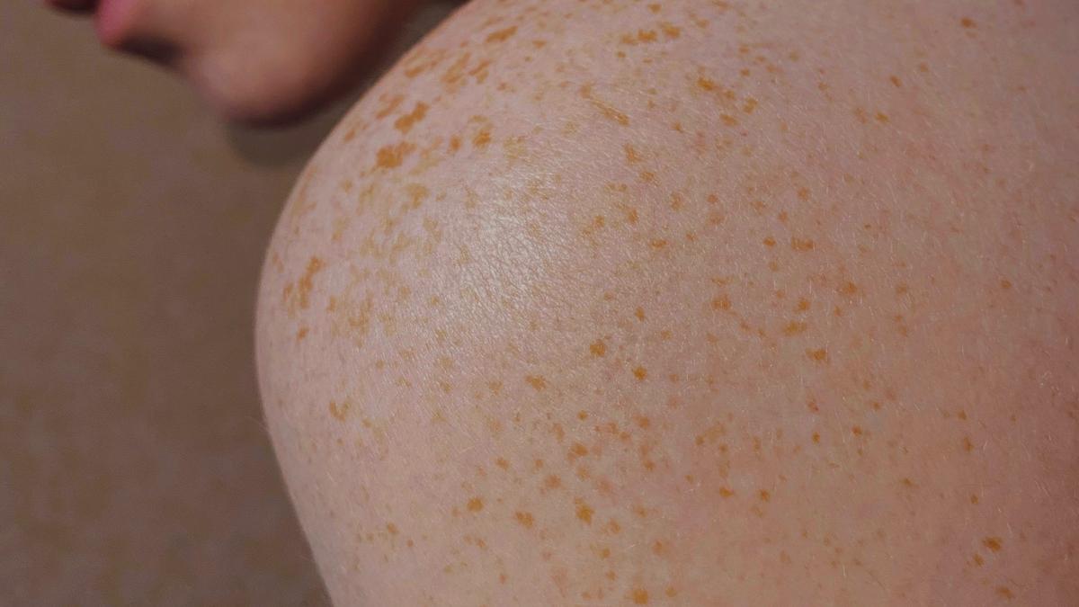 3 Gejala Khas Campak Saat Dewasa yang Sering Terlewat