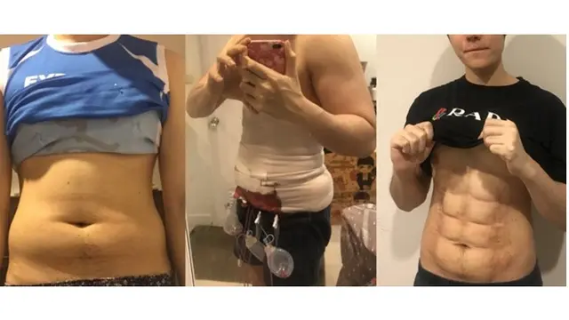 Pria Ini Rela Lakukan Operasi Plastik Demi Punya Perut Six Pack Hasilnya Bikin Geleng Kepala