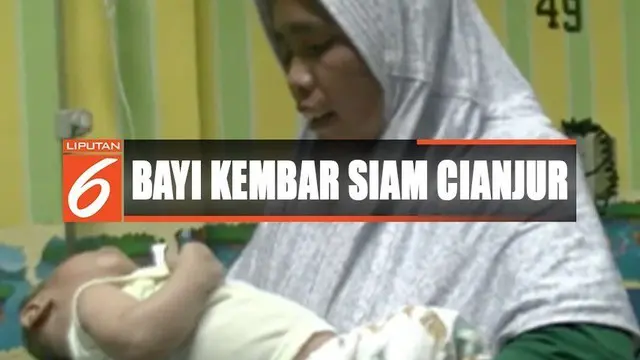 Kondisi Melemah, Bayi Kembar Siam Langka Dirawat