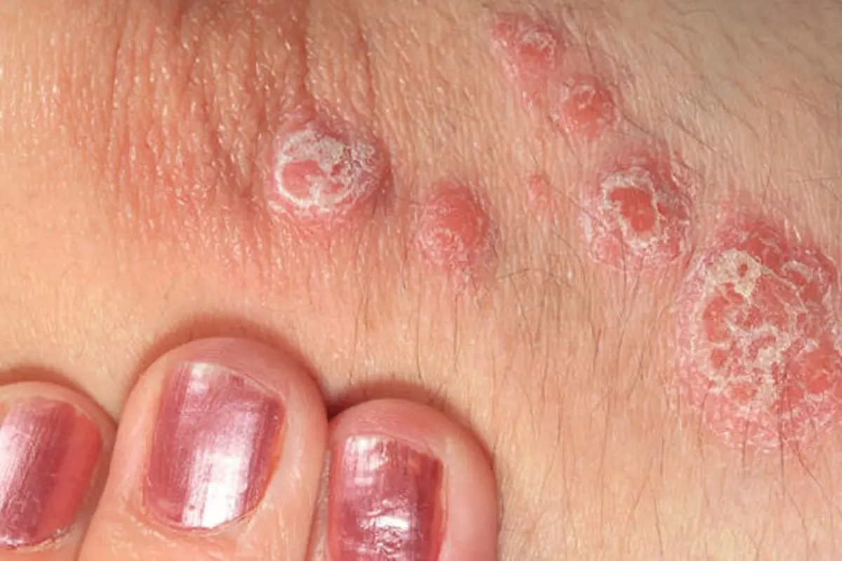 Kurangi Rasa Gatal Akibat Psoriasis dengan 3 Cara Ini