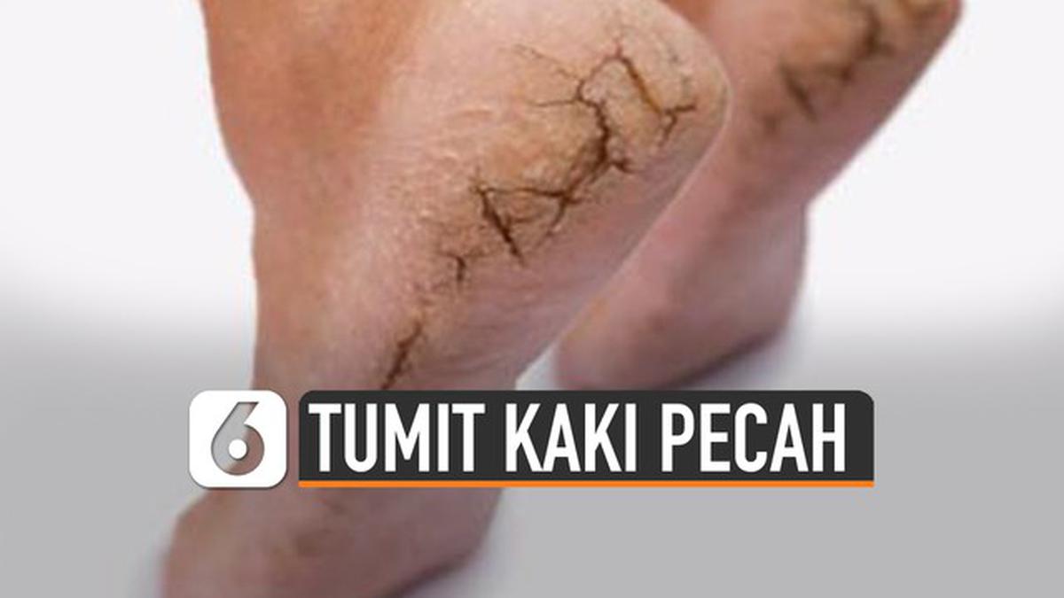 VIDEO: Hal Sepele Penyebab Tumit Kaki Pecah-Pecah