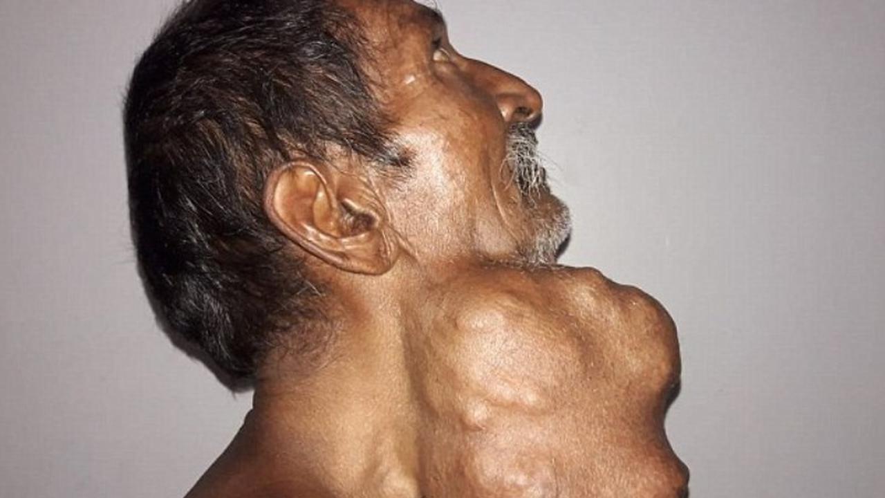 Dibiarkan 20 Tahun, Tumor 1,4 Kg di Kelenjar Ludah Pria Ini Akhirnya Diangkat