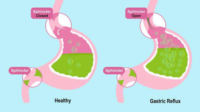 Ilustrasi asam lambung (Sumber: Istockphoto)