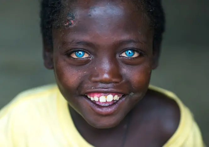 Bocah 8 tahun asal Afrika mengalami sindrom waardenburg. Source: wereblog.com