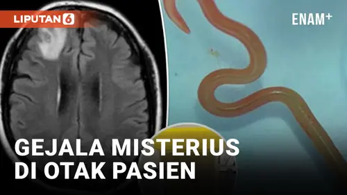 VIDEO: Cacing Sepanjang 8 Sentimeter Ditemukan di Otak Pasien di Australia
