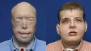 Perbedaan muka Patrick Hardison sebelum dan sesudah melakukan bedah plastik di Langone Medical Center NYU, New York, Amerika Serikat, (16/11/2015). Diperkirakan total biaya mencapat 1 juta dollar. (REUTERS)