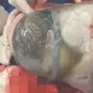 Bayi kembar terekam kamera terlahir masih terbungkus dalam ketuban. Bagaimana ceritanya?