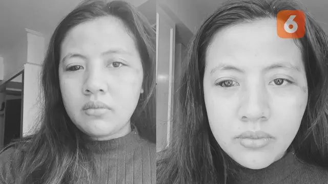 AG (30), korban penganiayaan anggota DPRD Takalar (Liputan6.com/Istimewa)