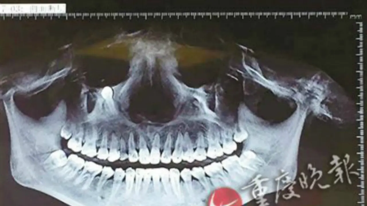 Impacted teeth (1)